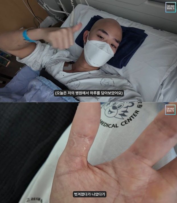 白血病で闘病中のチャ・ヒョンスンが近況報告　「皮膚がはがれ落ちる」